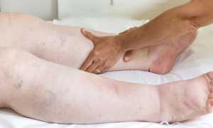 Сердечные отеки — причины и симптомы, диагностика, способы лечения и профилактика, возможные осложнения