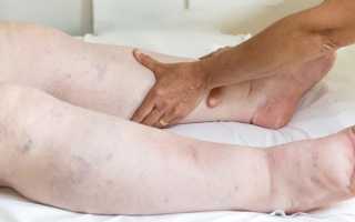 Сердечные отеки — причины и симптомы, диагностика, способы лечения и профилактика, возможные осложнения