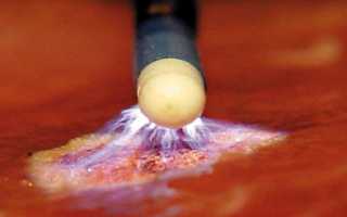 Как проводится и когда назначается прижигание эрозии аргоном?