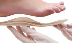 Стельки при вальгусной деформации стопы у детей — как выбрать по виду, материалу изготовления