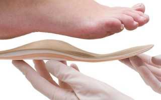 Стельки при вальгусной деформации стопы у детей — как выбрать по виду, материалу изготовления