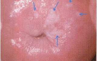 Дискератоз шейки матки: симптомы опасного заболевания