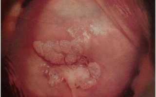 Кондилома на слизистой шейки матки: причины, симптомы, диагностика, лечение