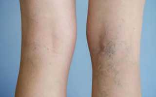 Что представляет собой варикоз при беременности?