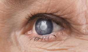 Причины врожденной катаракты — генетика, инфекции и нарушения обмена