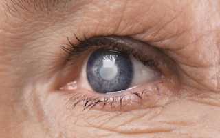 Причины врожденной катаракты — генетика, инфекции и нарушения обмена