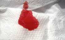 Патологические и нормальные выделения после удаления матки