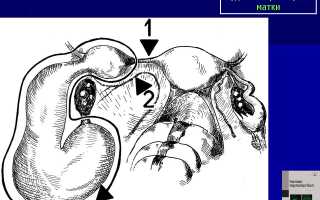Что такое рудиментарный рог матки?