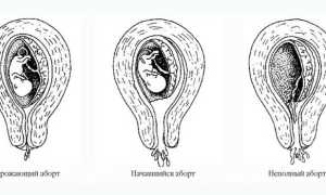 Угроза выкидыша на ранних сроках беременности: симптомы и лечение
