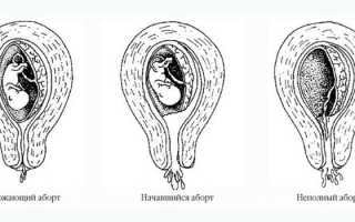 Угроза выкидыша на ранних сроках беременности: симптомы и лечение