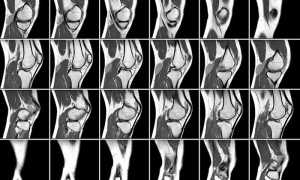 МРТ коленного сустава