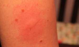 Реакция на прививку от гепатита