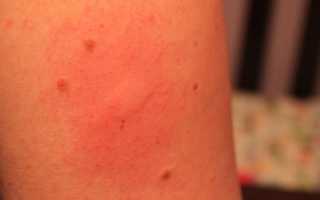 Реакция на прививку от гепатита