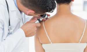 Удаление папиллом