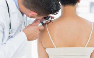 Удаление папиллом