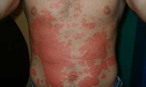 Можно ли загорать в солярии при псориазе