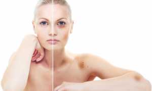 Как быстро убрать синяк