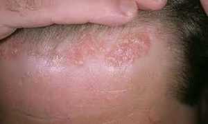 Методы лечения и профилактика жирной себореи