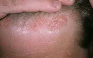 Методы лечения и профилактика жирной себореи