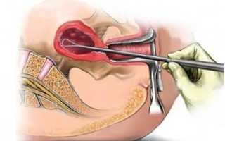 Реально ли забеременеть после чистки матки?