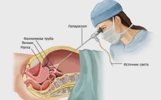 Удаление яичников при раке молочной железы