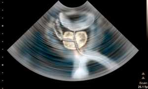 Простатит и бесплодие: что делать и как лечить