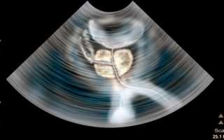 Простатит и бесплодие: что делать и как лечить