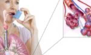 Лечение и профилактика молочницы на половых органах у мужчин