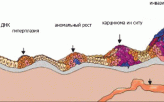 Карцинома in situ шейки матки: что представляет собой заболевание?