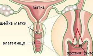 Уреаплазма у женщин — причины возникновения, симптомы, диагностика и схема лечения