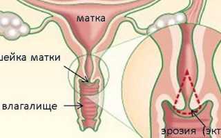 Уреаплазма у женщин — причины возникновения, симптомы, диагностика и схема лечения