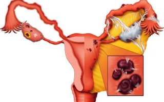 Вобэнзим при эндометриозе: особенности применения