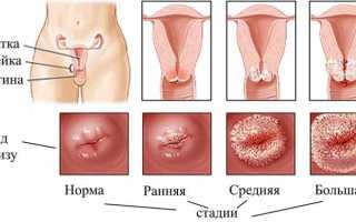 Какие анализы необходимы при эрозии шейки матки?