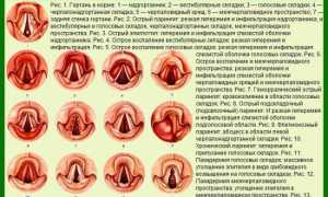 Ларингит у детей и взрослых