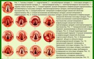 Ларингит у детей и взрослых