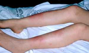 Профилактика псевдотуберкулеза — пути заражения и гигиенические меропиятия