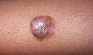 Опухоли кожи — признаки доброкачественных и злокачественных