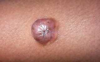 Опухоли кожи — признаки доброкачественных и злокачественных