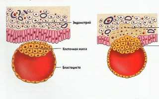 Какие в норме возникают ощущения при имплантации эмбриона в матку?