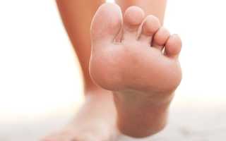 Как лечить грибок стопы в домашних условиях медикаментозными и народными средствами