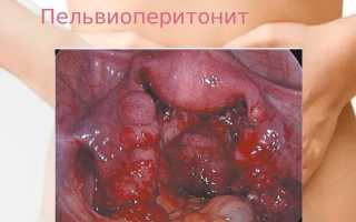Пельвиоперитонит: всё, что нужно знать о заболевании