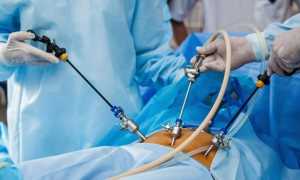 Осложнения после лапароскопии желчного пузыря — последствия и методы профилактики