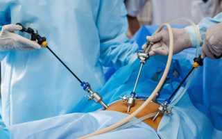 Осложнения после лапароскопии желчного пузыря — последствия и методы профилактики