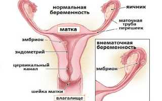 Внематочная беременность: психосоматика и ментальные причины патологии