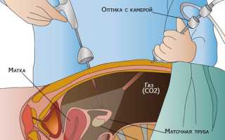 Хирургическое вмешательство при эндометриозе