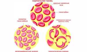 Гемолитическая анемия — причины возникновения, симптомы и диагностика
