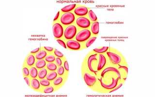 Гемолитическая анемия — причины возникновения, симптомы и диагностика