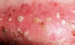 Первые и основные меры при обострение псориаза