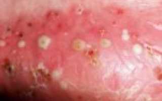 Первые и основные меры при обострение псориаза