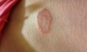 Что такое Итразол и с чем он борется?